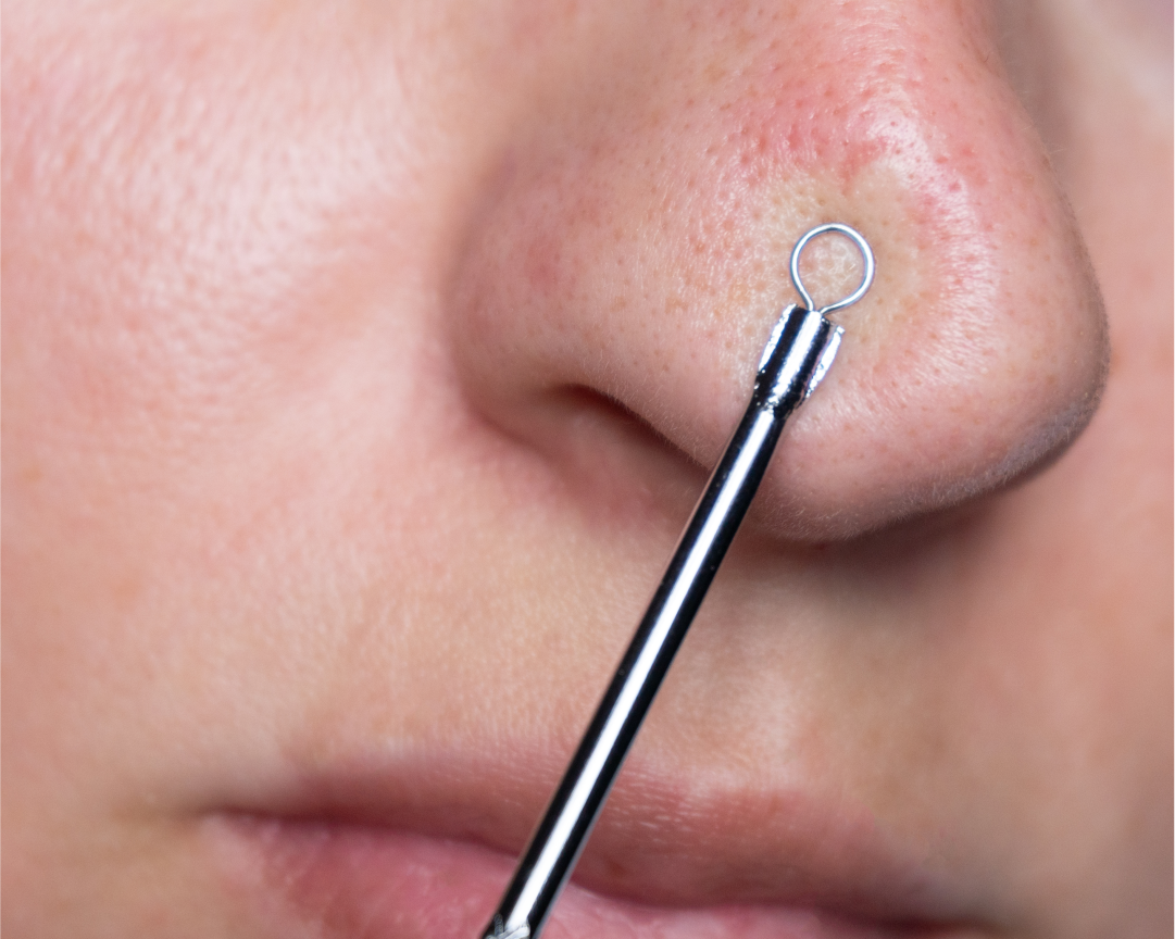 Come togliere i punti neri? I prodotti efficaci da usare | Royal Beauty