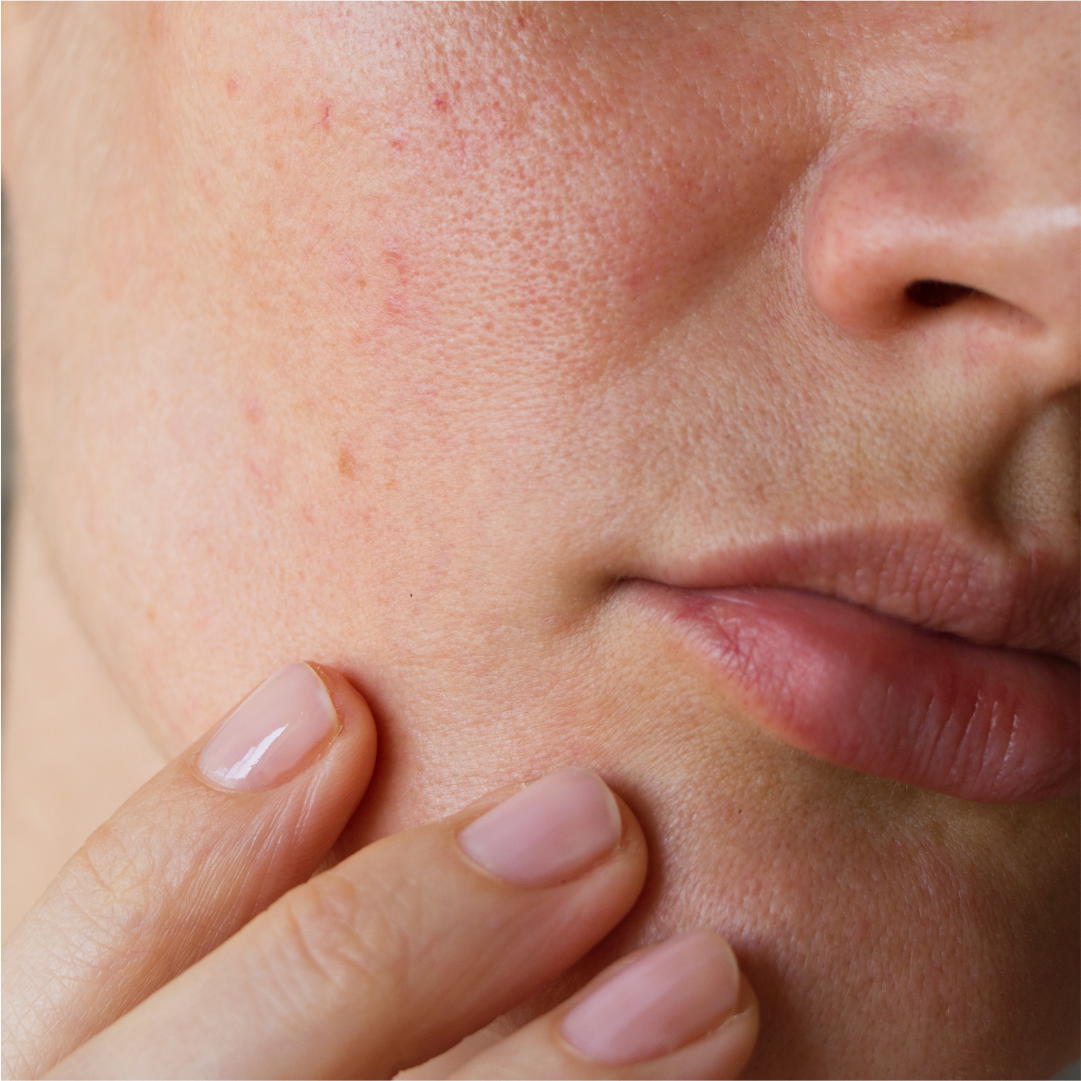 Come togliere i brufoli: consigli e rimedi | Royal Beauty