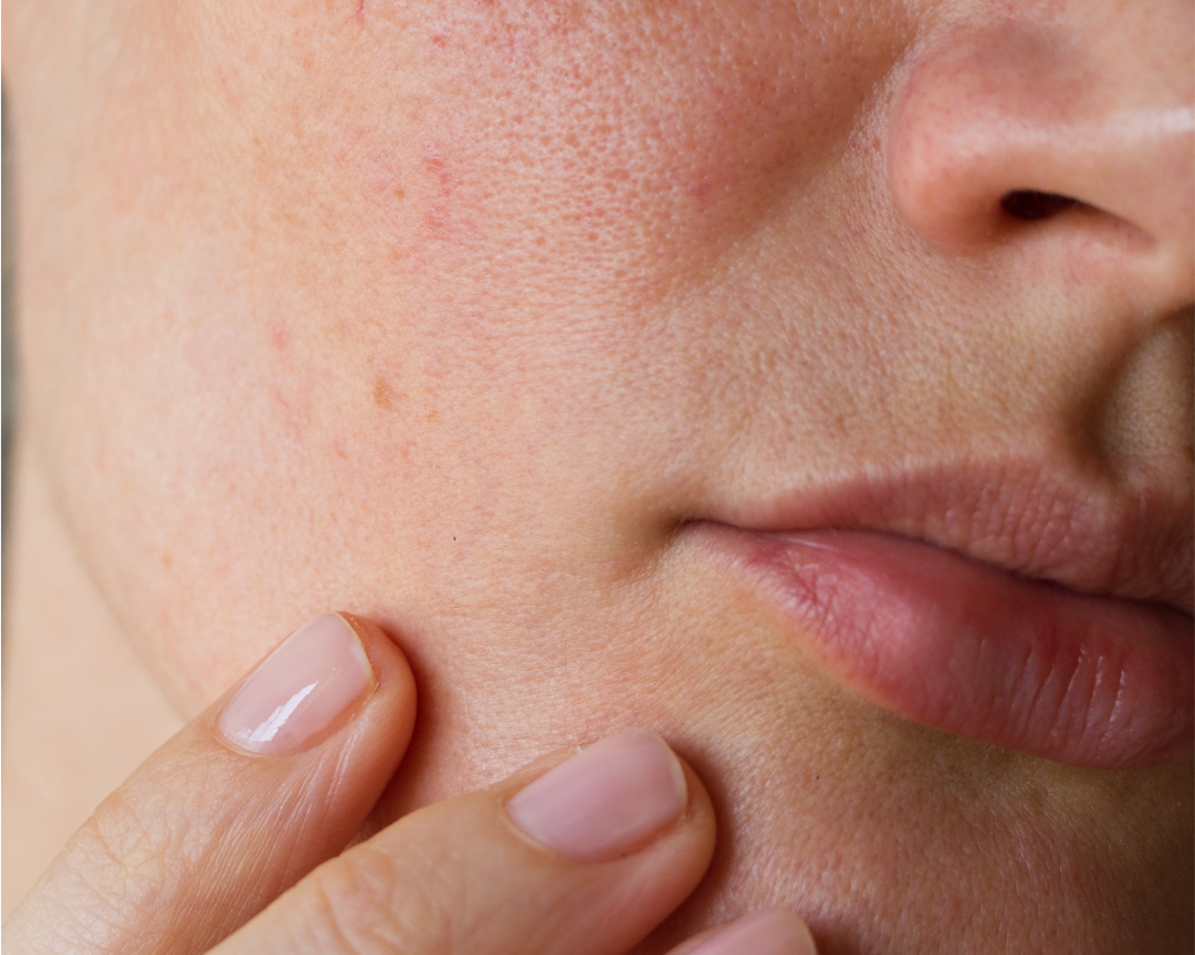 Come togliere i brufoli: consigli e rimedi | Royal Beauty